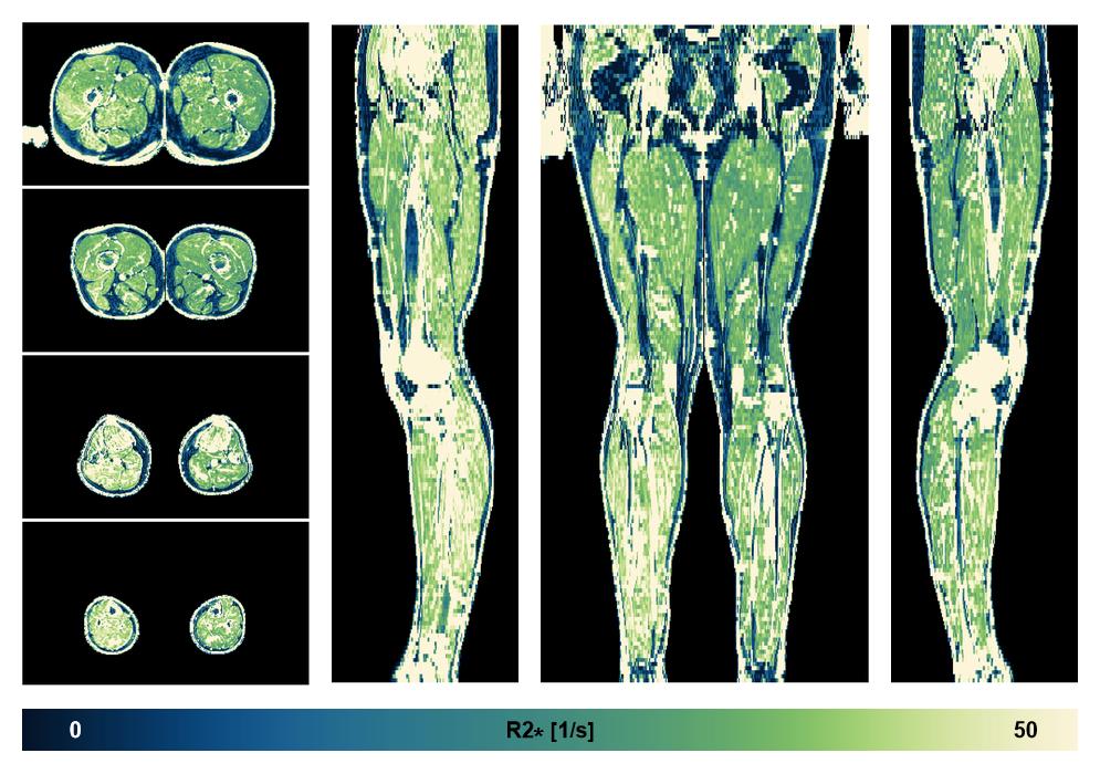 The R2 star relaxation time of the lower extremity obtained from the dixon reconstruction for muscle water fat quantification.