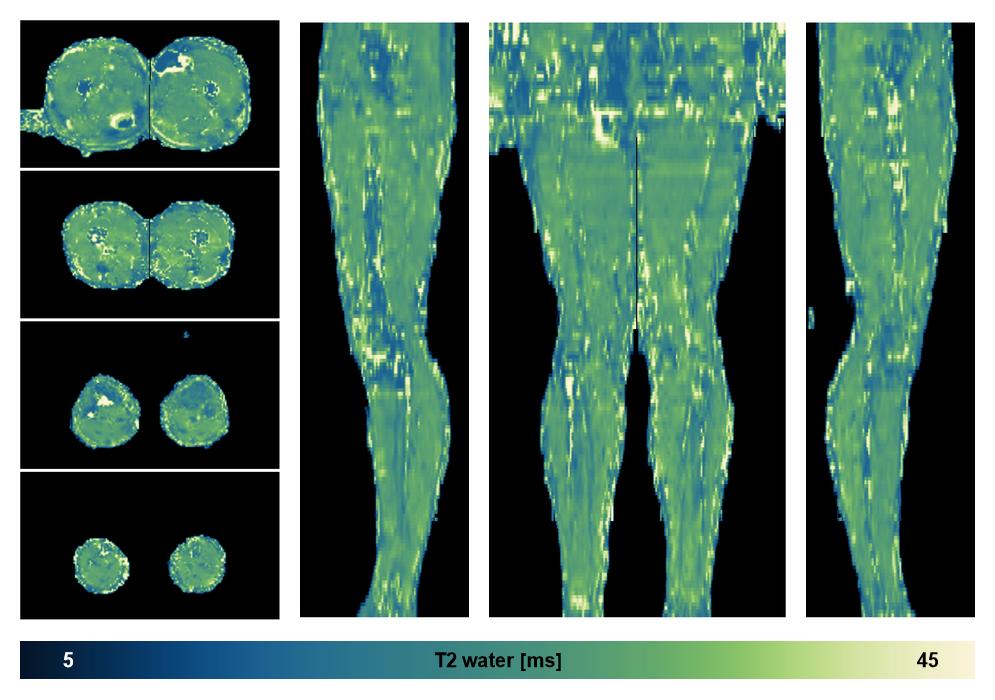 The water only T2 relaxation time of the lower extremity obtained from multi echo spin echo t2 mapping with EPG based reconstruction.