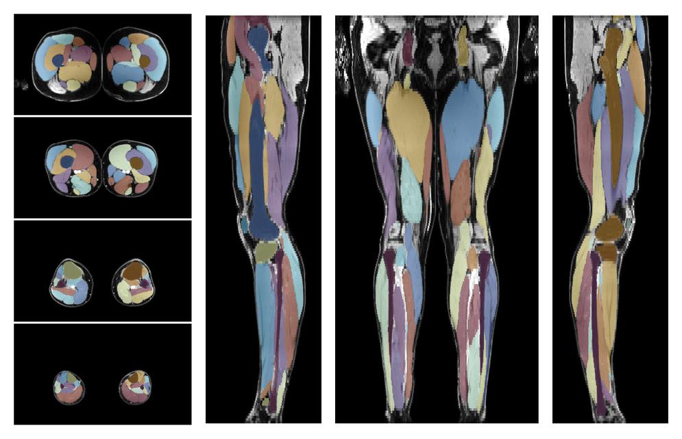 Overlay of automated muscle segmentation labels on dixon water image.