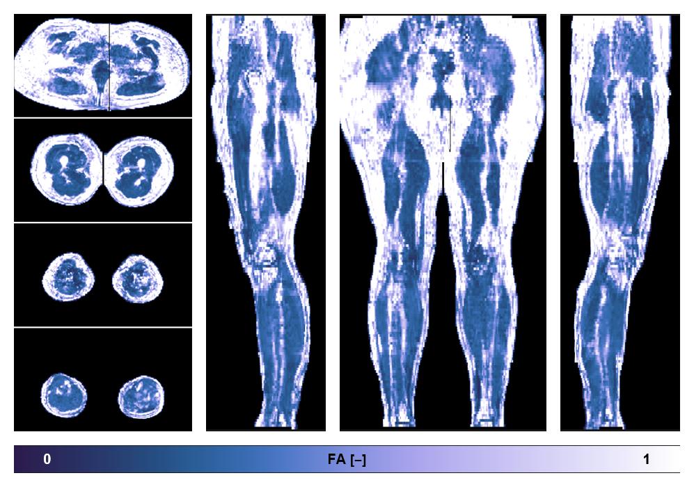 IVIM corrected whole leg muscle fractional anisotropy obtained from diffusion tensor imaging.