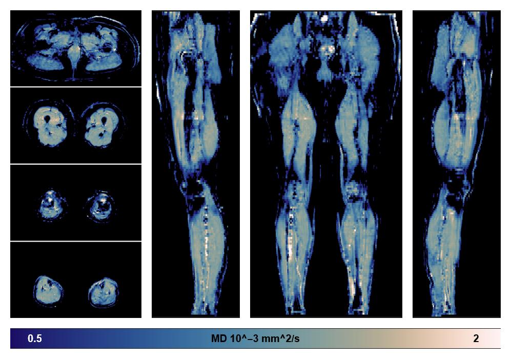IVIM corrected whole leg muscle mean diffusivity obtained from diffusion tensor imaging.