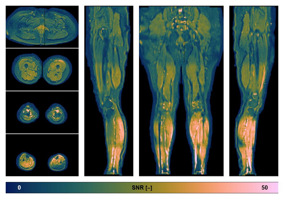 SNR distribution of the unweighted diffusion data.