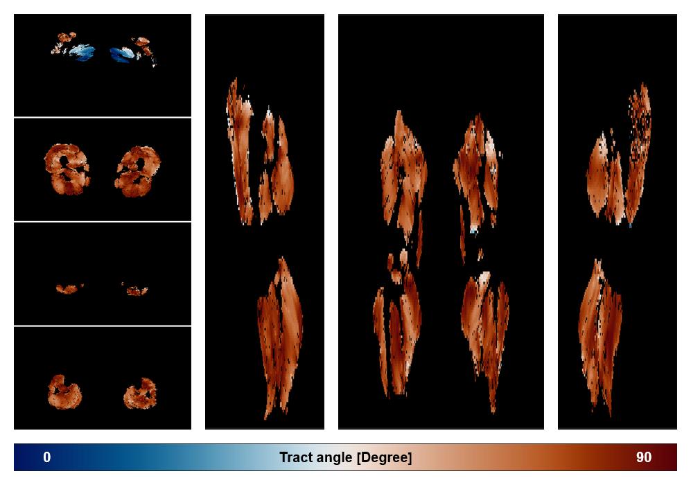 Muscle fiber tract angle map based on whole leg DTI based fiber tractography.
