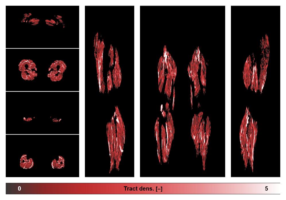 Muscle fiber tract density map based on whole leg DTI based fiber tractography.