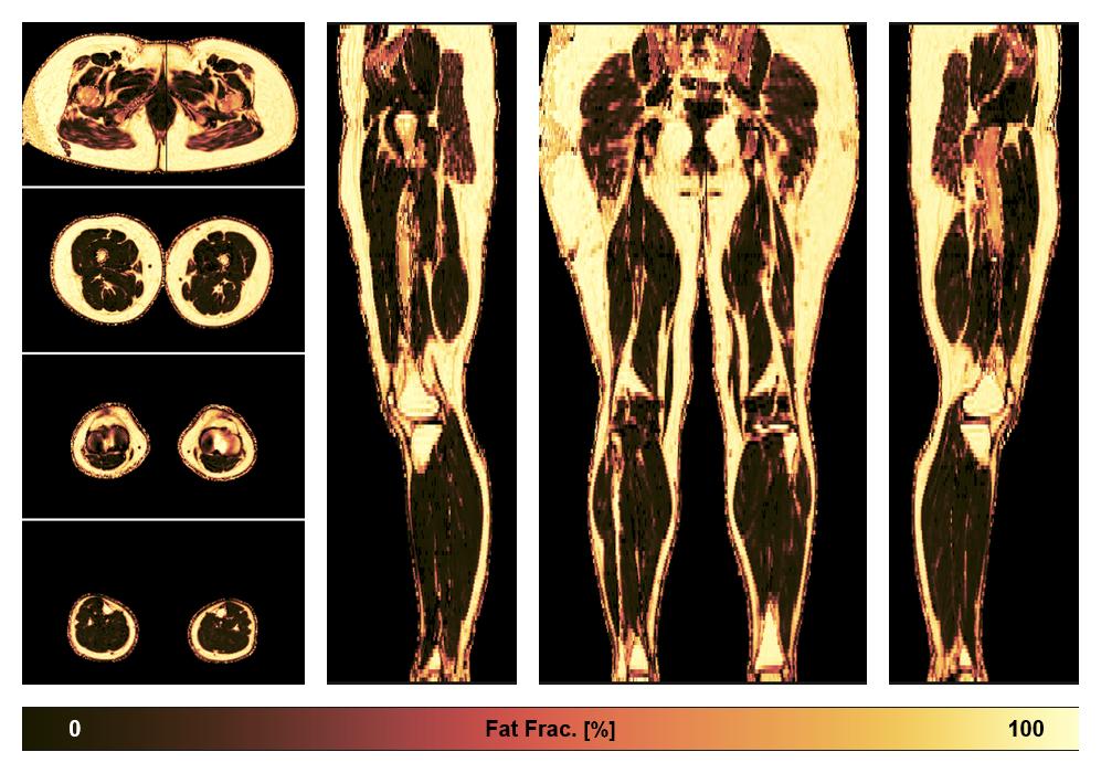 The fat fraction of the lower extremity obtained from the dixon reconstruction for muscle water fat quantification.