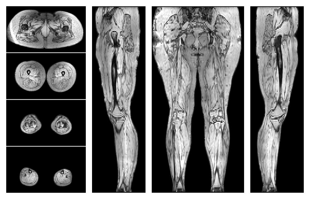 The out-phase image of the dixon reconstruction for water fat quantification.