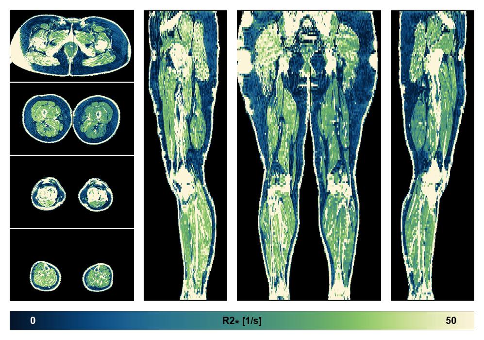 The R2 star relaxation time of the lower extremity obtained from the dixon reconstruction for muscle water fat quantification.
