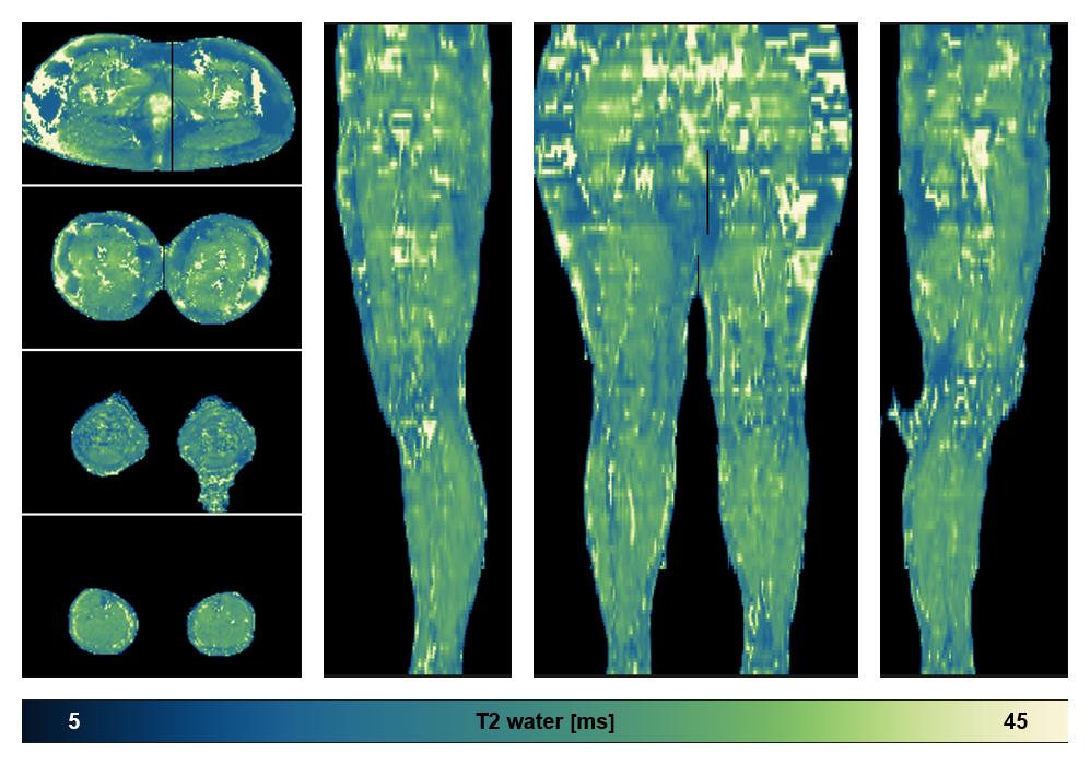 The water only T2 relaxation time of the lower extremity obtained from multi echo spin echo t2 mapping with EPG based reconstruction.