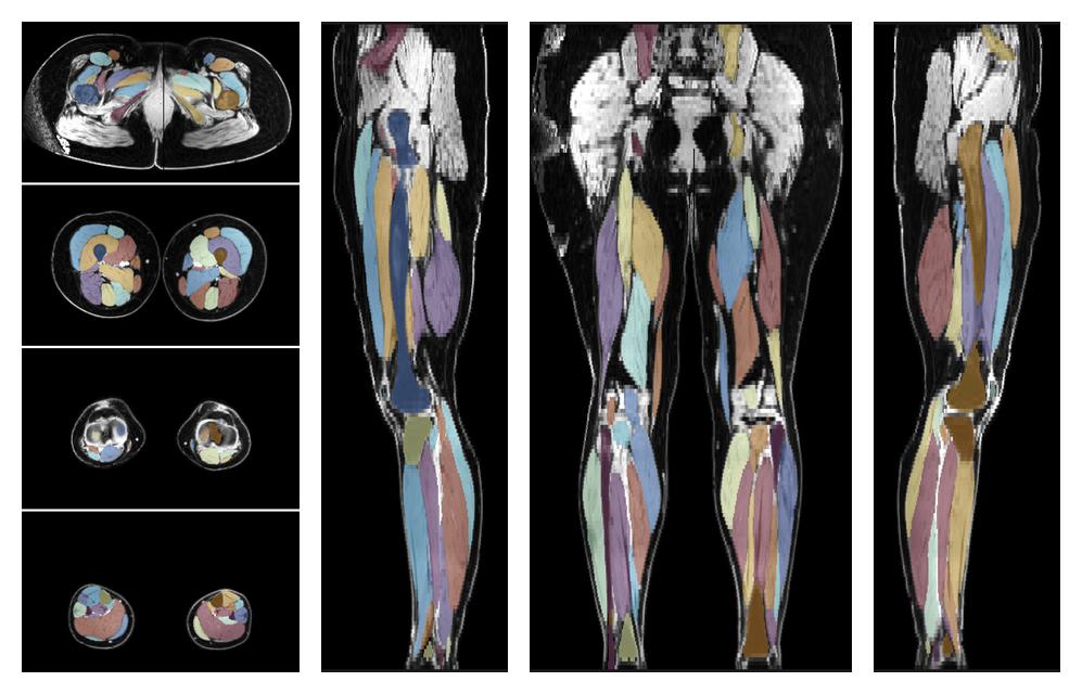 Overlay of automated muscle segmentation labels on dixon water image.