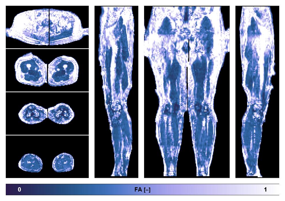 IVIM corrected whole leg muscle fractional anisotropy obtained from diffusion tensor imaging.