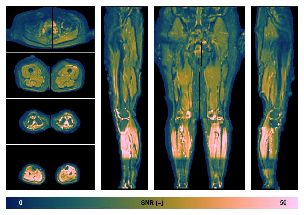 SNR distribution of the unweighted diffusion data.
