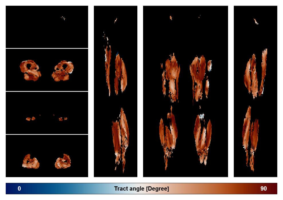 Muscle fiber tract angle map based on whole leg DTI based fiber tractography.