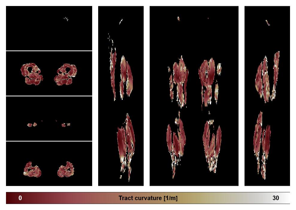 Muscle fiber tract curvature map based on whole leg DTI based fiber tractography.