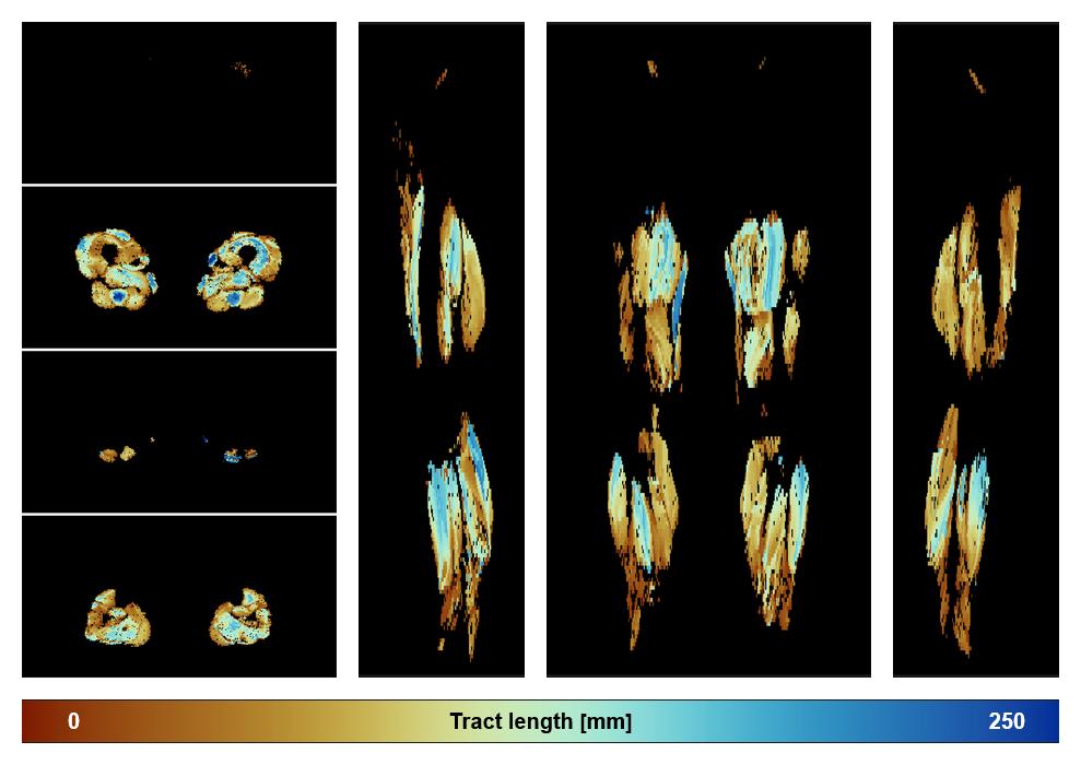 Muscle fiber tract length map based on whole leg DTI based fiber tractography.