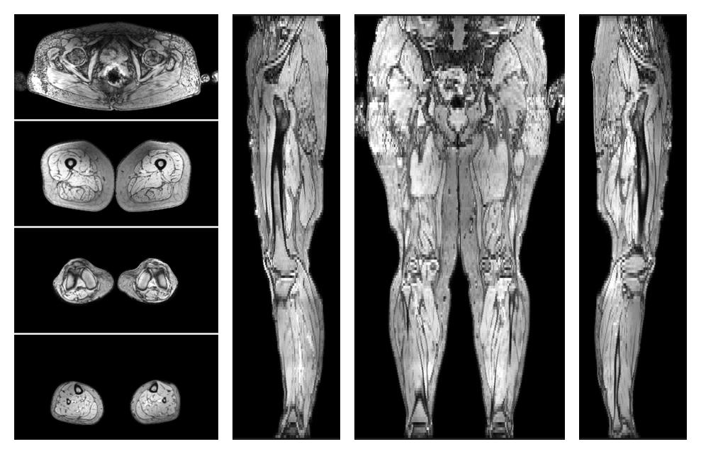 The out-phase image of the dixon reconstruction for water fat quantification.
