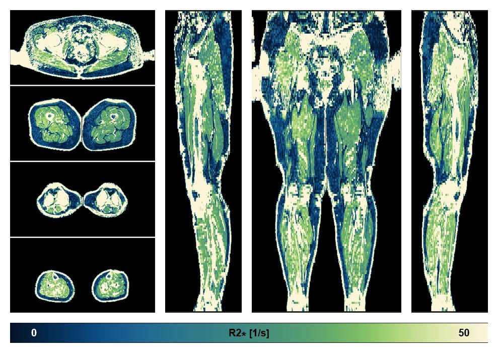The R2 star relaxation time of the lower extremity obtained from the dixon reconstruction for muscle water fat quantification.