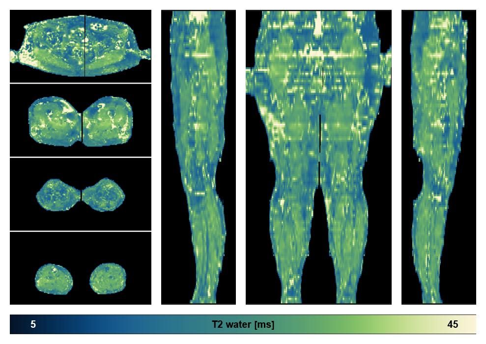 The water only T2 relaxation time of the lower extremity obtained from multi echo spin echo t2 mapping with EPG based reconstruction.