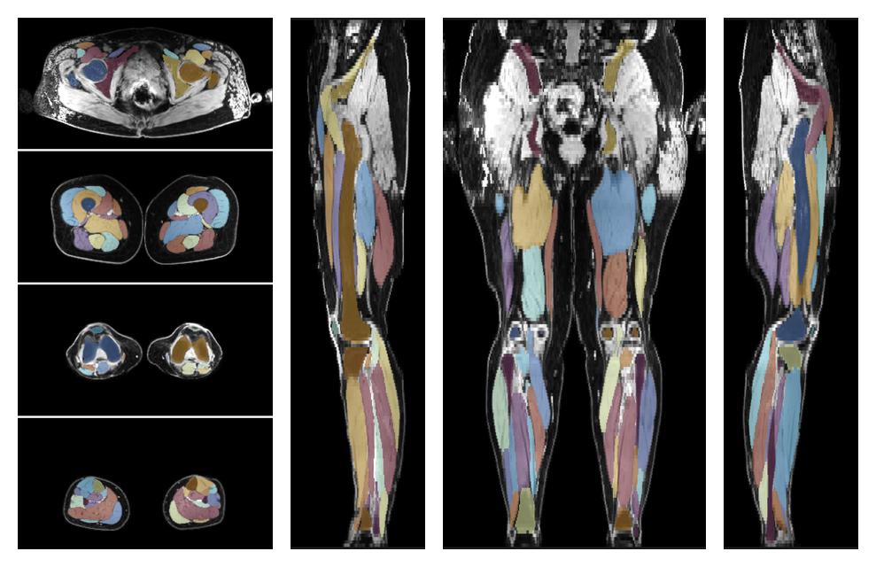 Overlay of automated muscle segmentation labels on dixon water image.