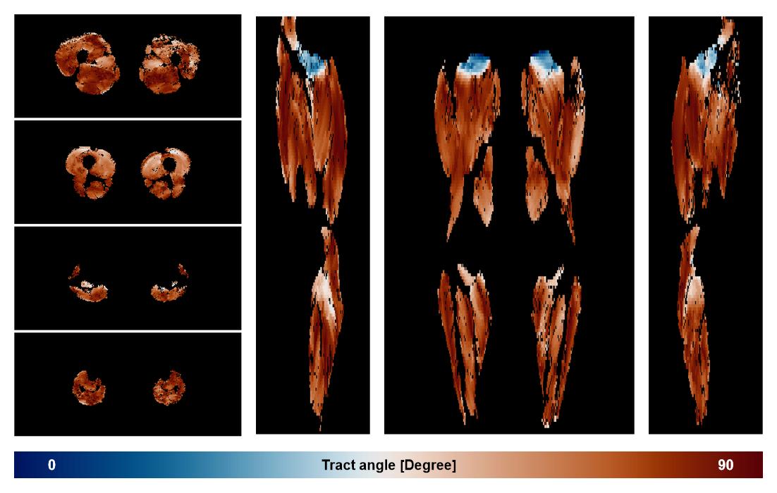 Muscle fiber tract angle map based on whole leg DTI based fiber tractography.
