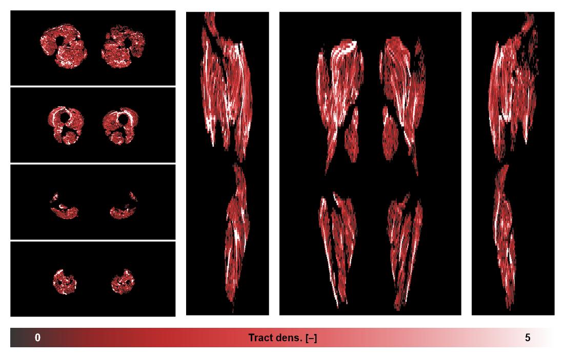 Muscle fiber tract density map based on whole leg DTI based fiber tractography.