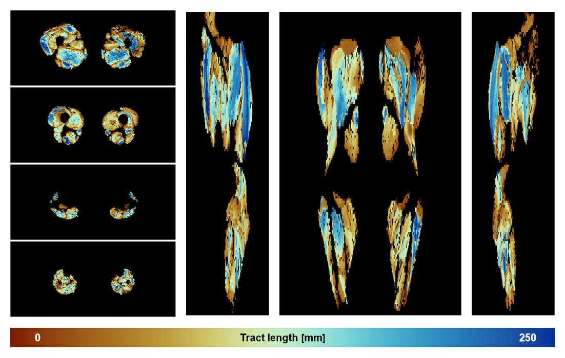 Muscle fiber tract length map based on whole leg DTI based fiber tractography.