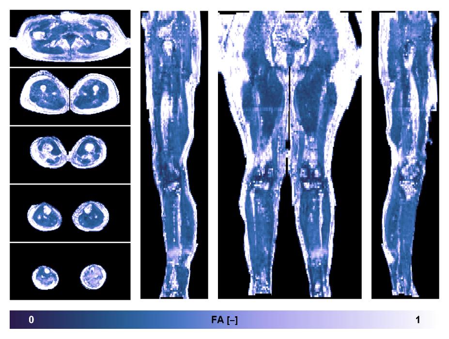IVIM corrected whole leg muscle fractional anisotropy obtained from diffusion tensor imaging.