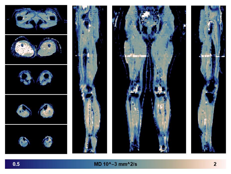 IVIM corrected whole leg muscle mean diffusivity obtained from diffusion tensor imaging.