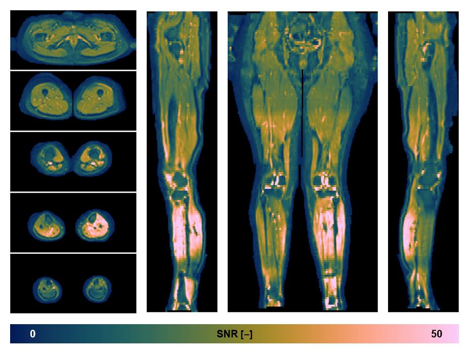 SNR distribution of the unweighted diffusion data.
