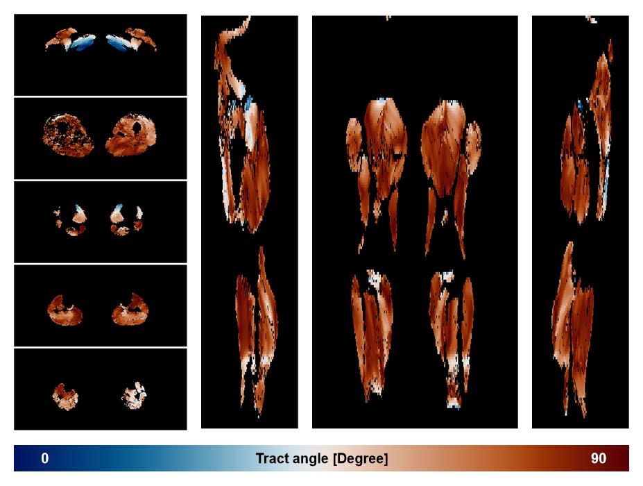 Muscle fiber tract angle map based on whole leg DTI based fiber tractography.