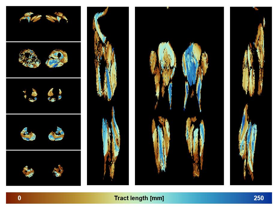 Muscle fiber tract length map based on whole leg DTI based fiber tractography.