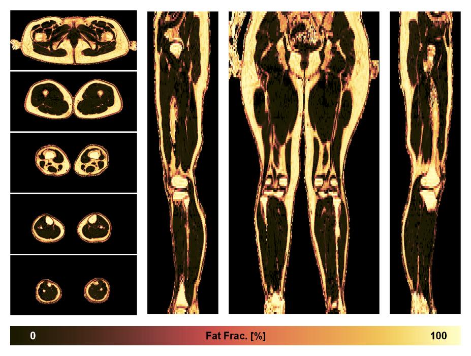 The fat fraction of the lower extremity obtained from the dixon reconstruction for muscle water fat quantification.