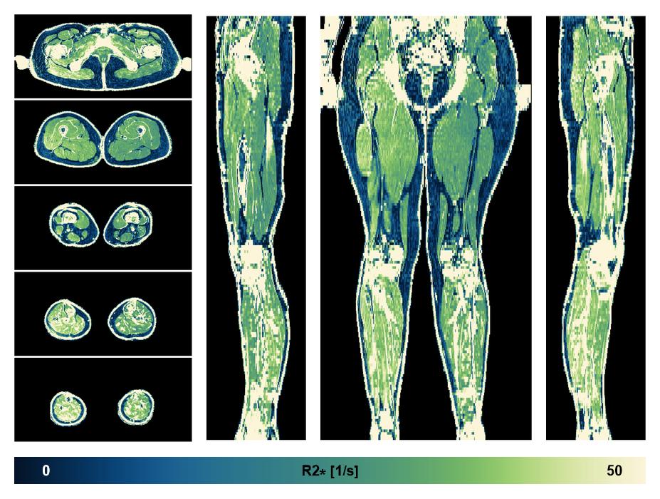 The R2 star relaxation time of the lower extremity obtained from the dixon reconstruction for muscle water fat quantification.