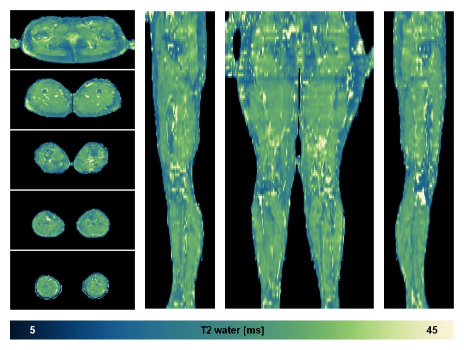 The water only T2 relaxation time of the lower extremity obtained from multi echo spin echo t2 mapping with EPG based reconstruction.