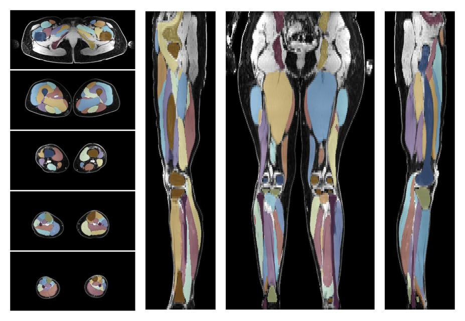 Overlay of automated muscle segmentation labels on dixon water image.