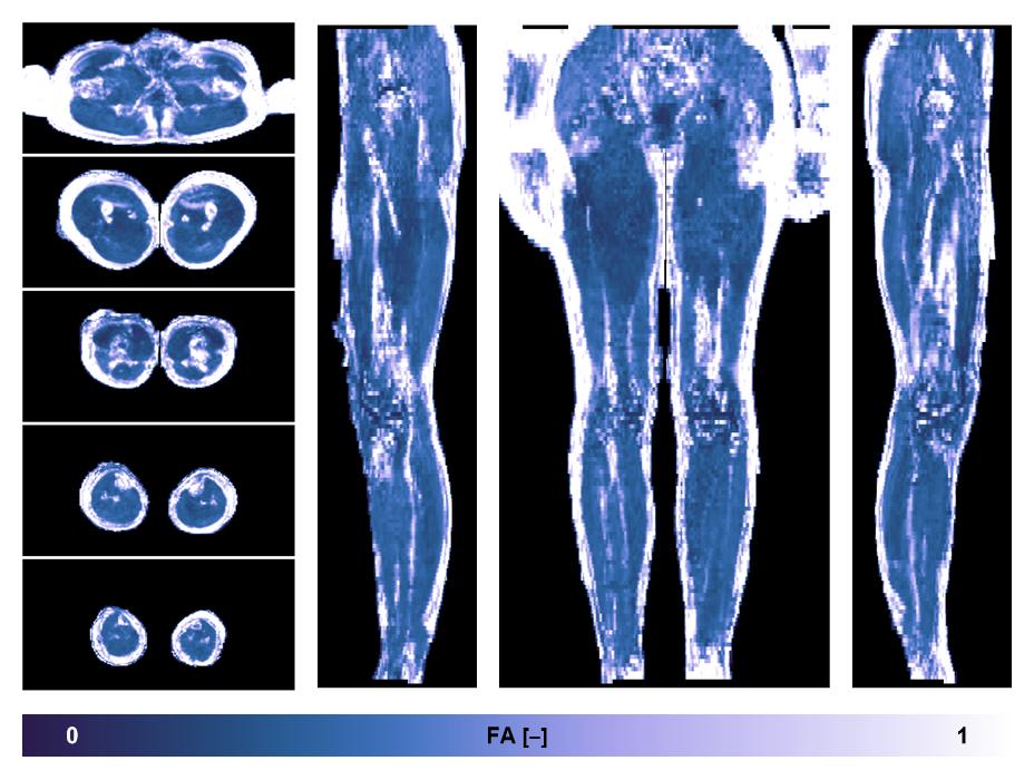 IVIM corrected whole leg muscle fractional anisotropy obtained from diffusion tensor imaging.