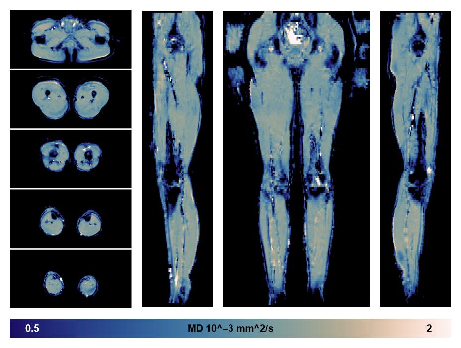 IVIM corrected whole leg muscle mean diffusivity obtained from diffusion tensor imaging.