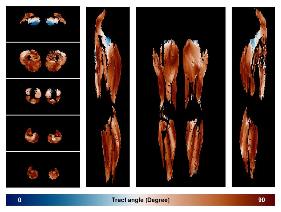 Muscle fiber tract angle map based on whole leg DTI based fiber tractography.