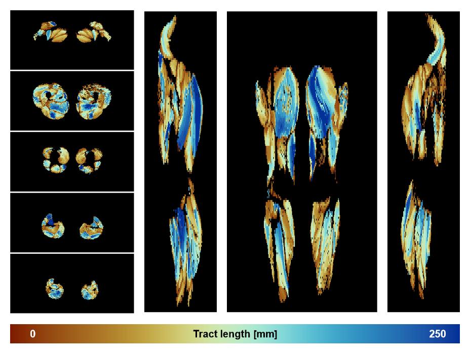 Muscle fiber tract length map based on whole leg DTI based fiber tractography.