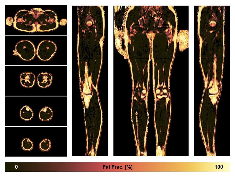 The fat fraction of the lower extremity obtained from the dixon reconstruction for muscle water fat quantification.