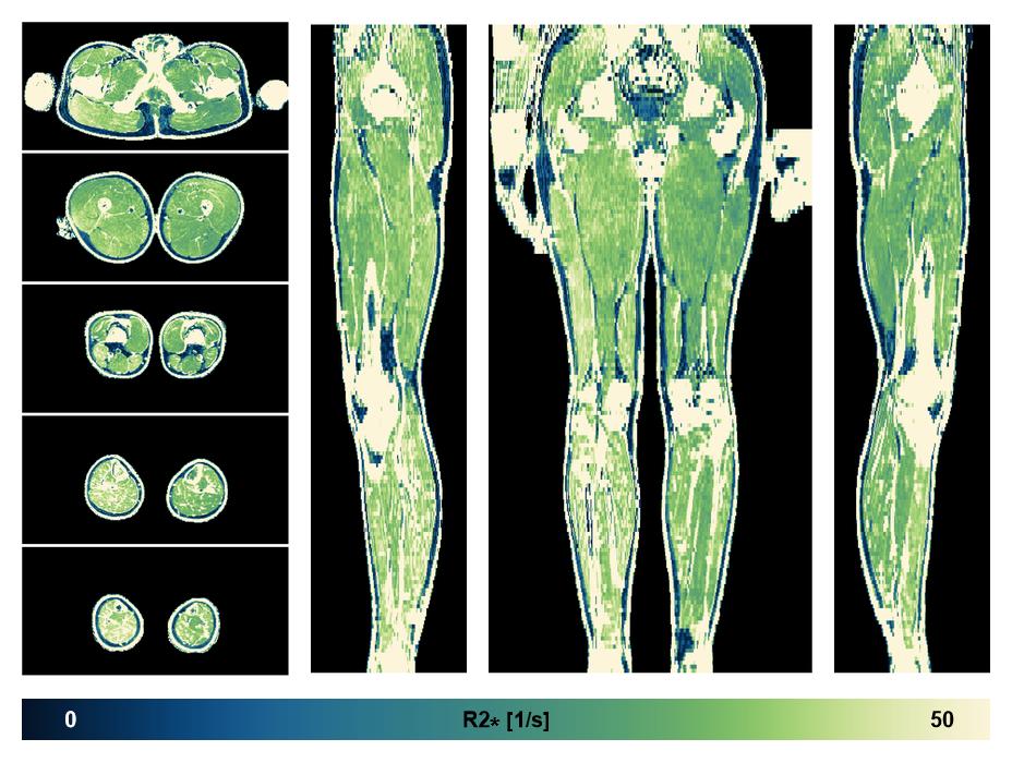 The R2 star relaxation time of the lower extremity obtained from the dixon reconstruction for muscle water fat quantification.