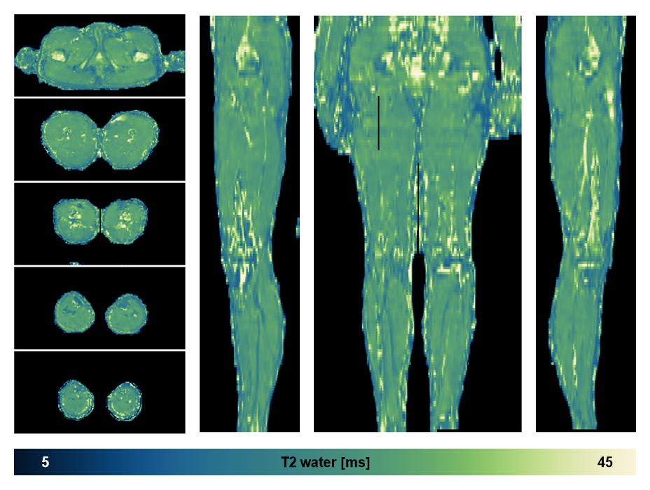 The water only T2 relaxation time of the lower extremity obtained from multi echo spin echo t2 mapping with EPG based reconstruction.