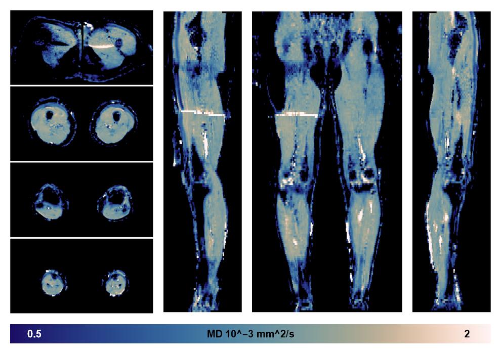 IVIM corrected whole leg muscle mean diffusivity obtained from diffusion tensor imaging.