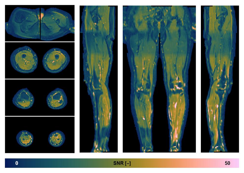 SNR distribution of the unweighted diffusion data.