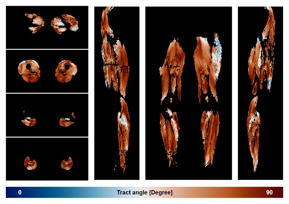 Muscle fiber tract angle map based on whole leg DTI based fiber tractography.