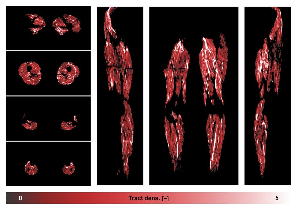 Muscle fiber tract density map based on whole leg DTI based fiber tractography.