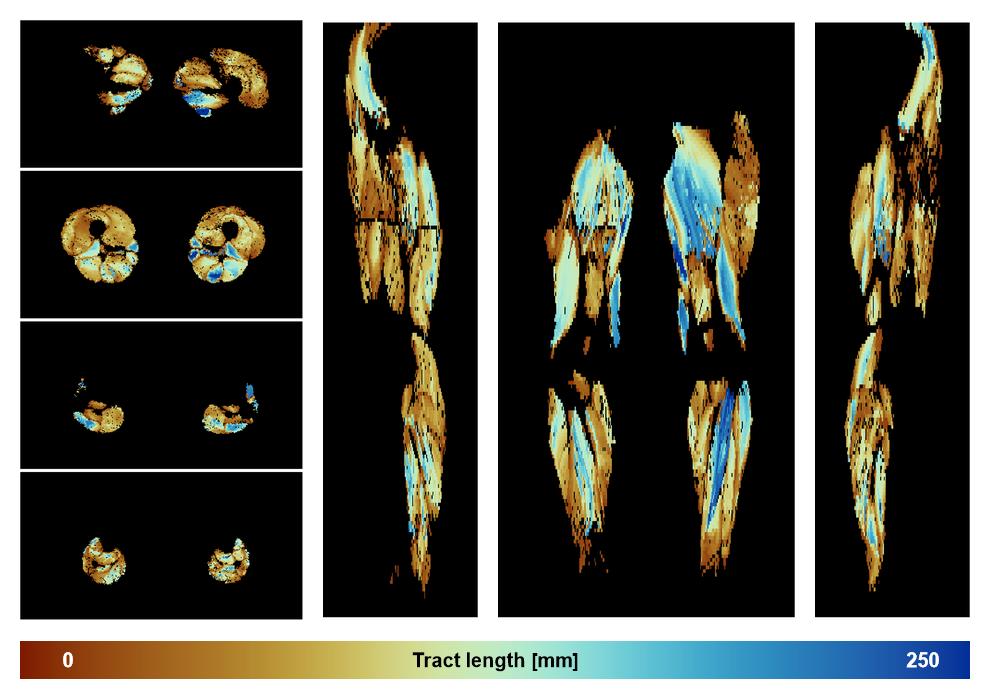 Muscle fiber tract length map based on whole leg DTI based fiber tractography.
