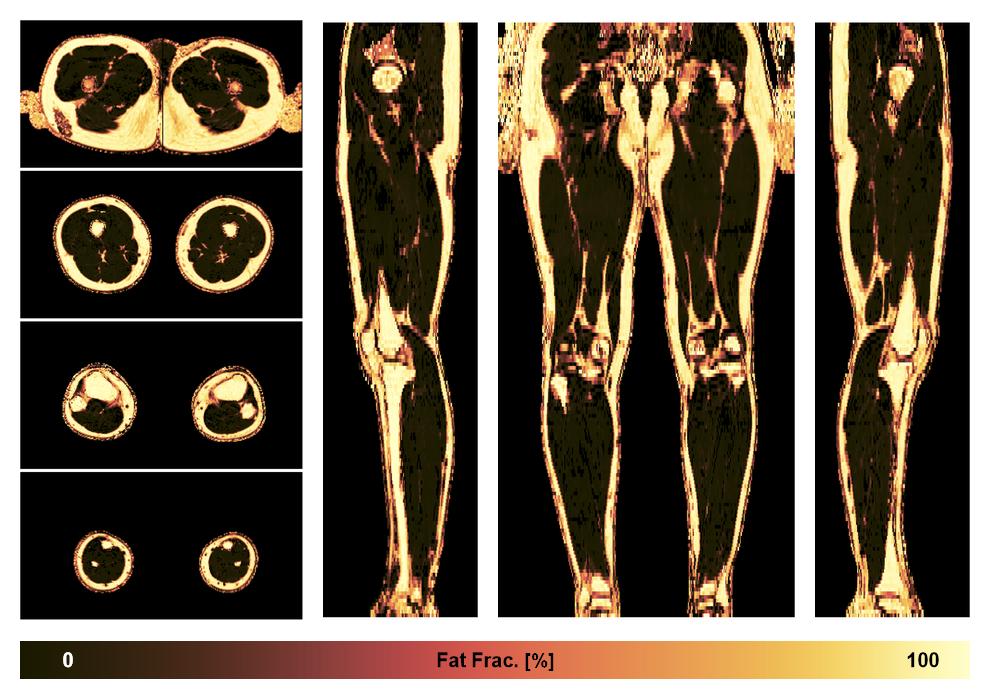 The fat fraction of the lower extremity obtained from the dixon reconstruction for muscle water fat quantification.