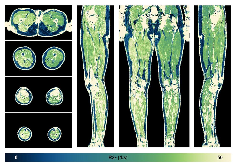 The R2 star relaxation time of the lower extremity obtained from the dixon reconstruction for muscle water fat quantification.