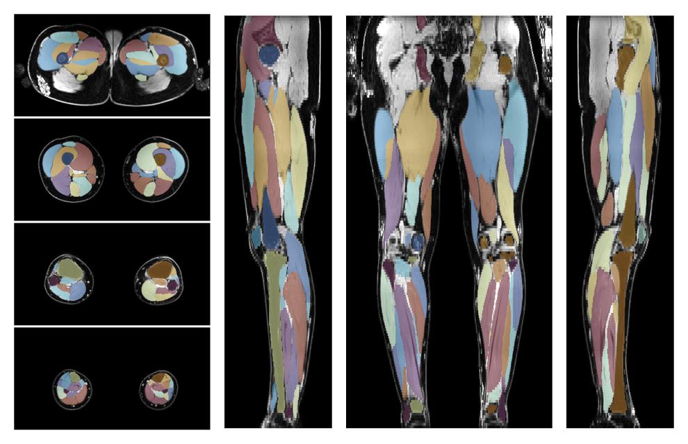 Overlay of automated muscle segmentation labels on dixon water image.