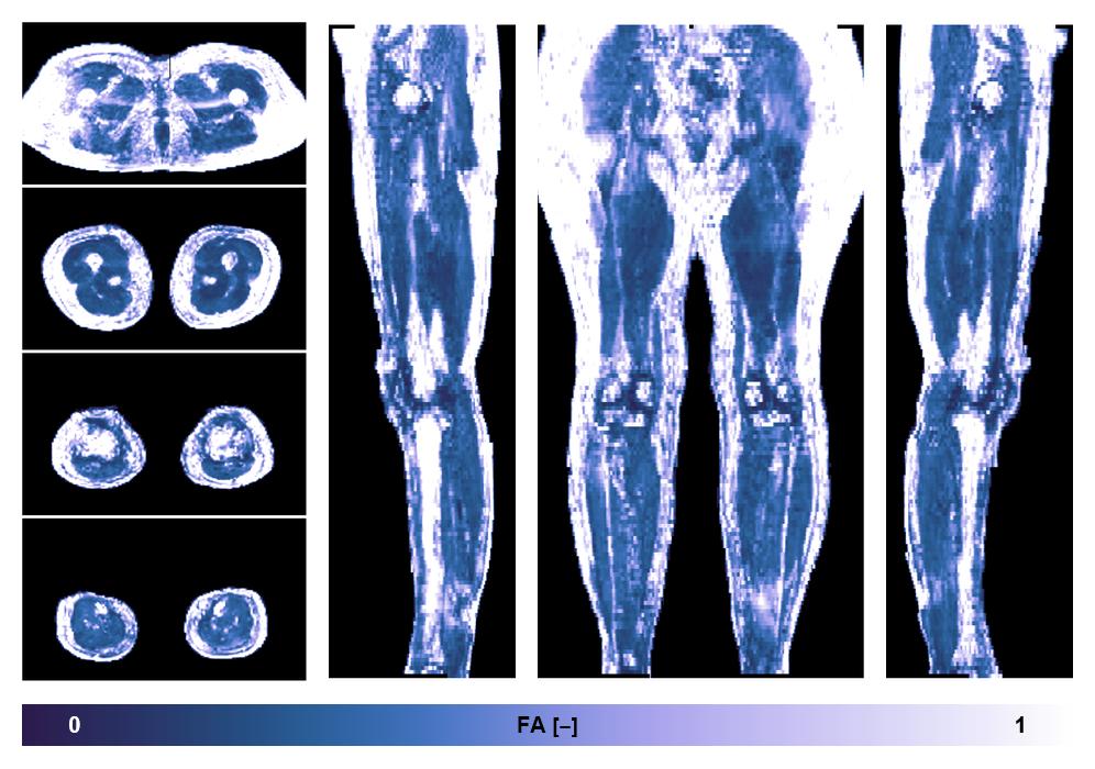 IVIM corrected whole leg muscle fractional anisotropy obtained from diffusion tensor imaging.